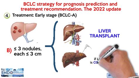 Barcelona Clinic Liver Cancer Bclc Staging System The 2022 Update Youtube