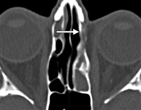 Failed Endoscopic Sinus Surgery Spectrum Of Ct Findings In The Frontal