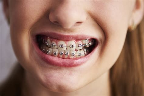 Braces Colours How To Pick The Best Braces Colour For Your Teeth The