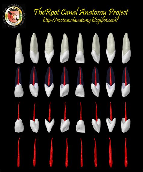 Maxillary Lateral Incisor