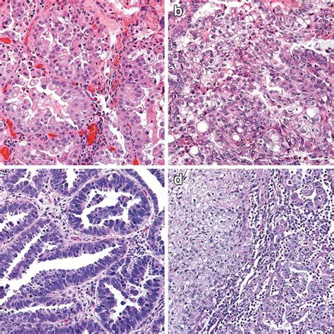 Microscopic Findings Of The Urinary Tract Clear Cell Adenocarcinoma