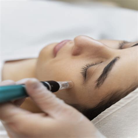 Los Angeles Microneedling An Ultimate Guide To Achieve Flawless Skin