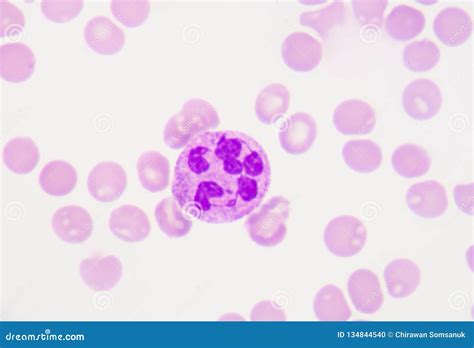 Hyper Segmanted Neutrophil Stock Photo Image Of Hemophilia