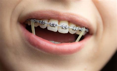 Para qué sirven las gomas de los brackets Loscos Ortodoncia