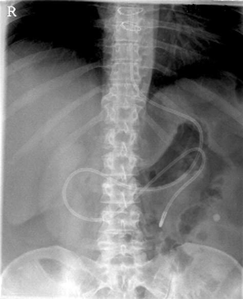 Sonda Nasoenteral Raio X - Raio X De Sonda Nasoenteral - BRAINCP