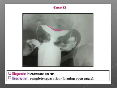 Hysterosalpingography