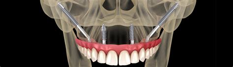 Refaire Toutes Ses Dents En Seule Intervention Mci En France Ou