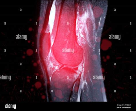 Magnetic Resonance Imaging Or Mri Of Knee Joint Sagittal T2 Fs For