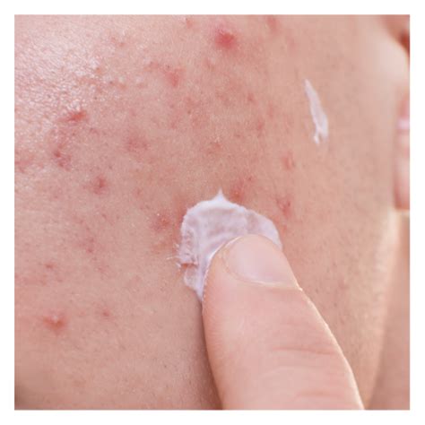 ACNE FÚNGICA SAIBA O QUE É E COMO TRATAR Blog Ada Tina