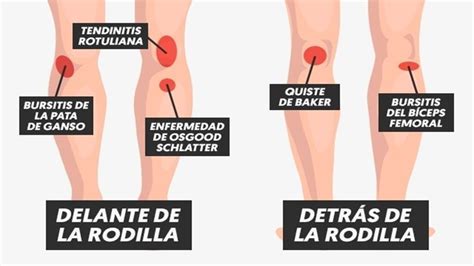 Dolor De Rodilla Qu Puede Causarlo Y C Mo Tratar Physical Therapy