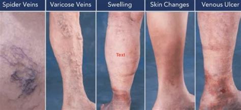 What Is Chronic Venous Insufficiency What Is Cvi