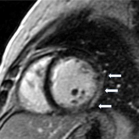 Short Axis Lge Image Showing Diffuse Subendocardial Fibrosis Arrows