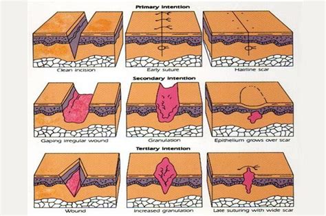 Overview Of Wound Management Diagram Quizlet