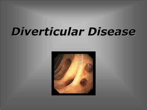 Ppt Inflammatory Bowel Disease Powerpoint Presentation Free Download Id6712579