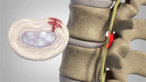 Hernia De Disc Cauze Simptome Si Tratament S N Tate Non Stop