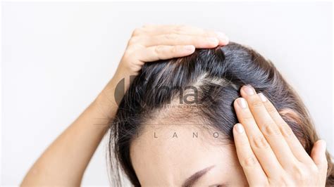 Female alopecia: causes and treatments explained by the trichologist ...