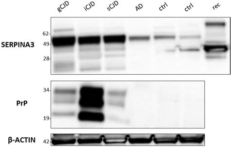 Western Blotting Analysis Of Brain Samples From Cjd Ad Patients And