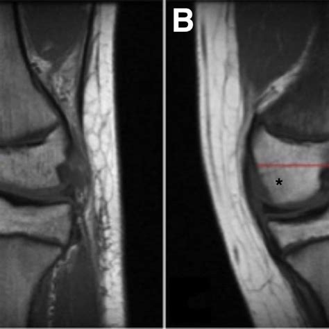 A Intercondylar Notch Width Measurement Intercondylar Notch Width