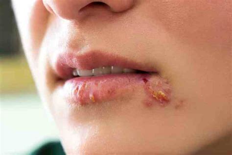 How to get rid of a pimple on lip: Cause & Treatments - ViewHealthy