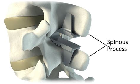 Lumbar Stabilization Spine Surgery Institute