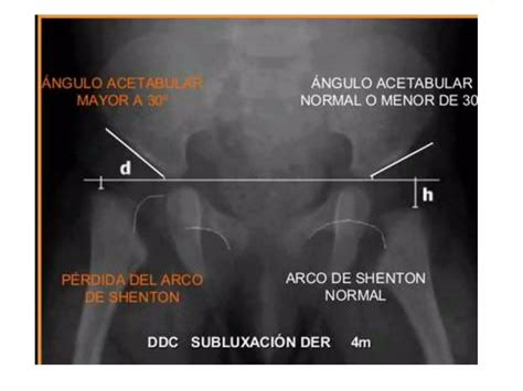 Luxación Congénita De Cadera Ppt