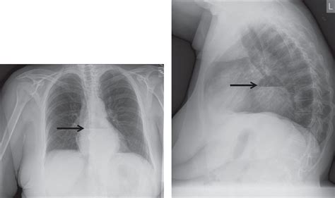 Open Paraesophageal Hernia And Hill Repair Open Abdominal Approach