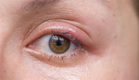 Faq Blepharitis And Blephex Treatment Whitby Vision Care In Whitby