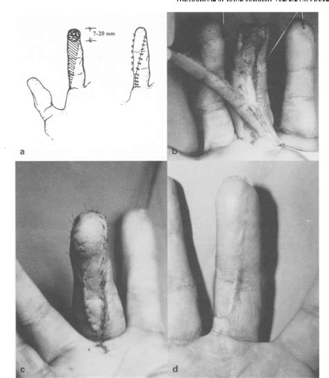 Figure 2 From Versatility Of The Homodigital Triangular Neurovascular Island Flap In Fingertip