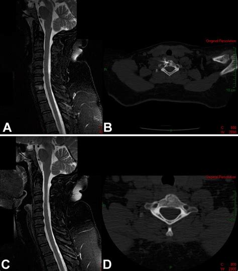 Sagittal T2 Weighted Mri With Fat Suppression Of The Cervical Spine Of