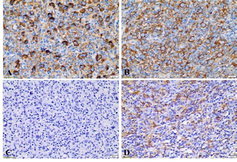 The Immunoreactivity Of CD163 PD L1 And NFATc1 Proteins Of Patient 2