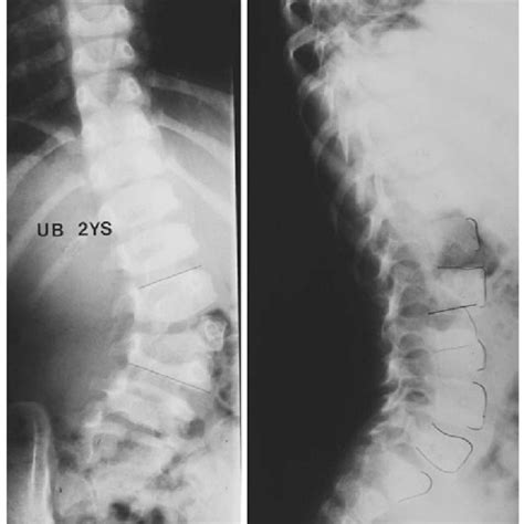 Ap And Lateral Preoperative Radiographs Of The Month Old Girl With