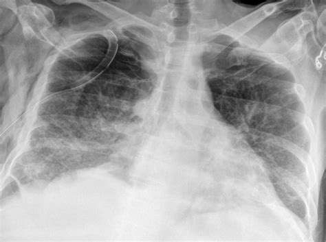 Abscess Drainage - Dr Zertalis