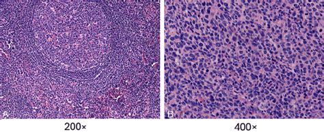 Morphology Of Hande Stained Dlbcl And Reactive Lymph Node Hyperplasia Download Scientific Diagram