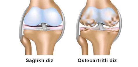 Diz Kireçlenme Osteoartrit Belirtileri ve Tedavisi