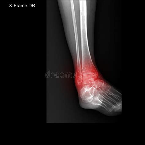 X-ray Tarsal and Ankle Painful Area. Stock Image - Image of normal ...