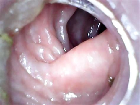 Free Endoscope Porn Videos XHamster