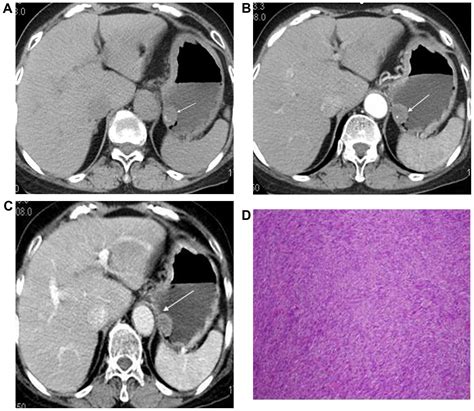 Computed Tomography Imaging Characteristics Of Synchronous