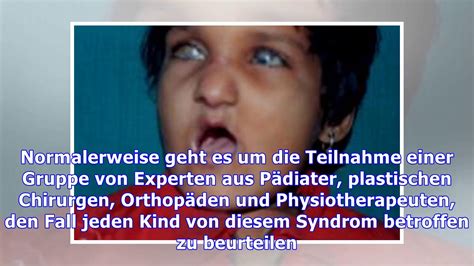 Hanhart Syndrom Youtube