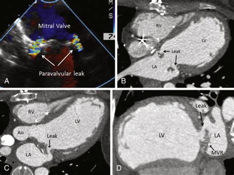 Assessment Of Prosthetic Heart Valves Radiology Key