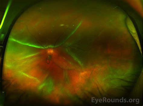 Bilateral Acute Retinal Necrosis