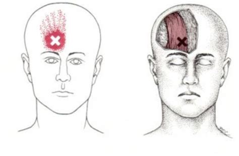 Trigger Points Flashcards Quizlet