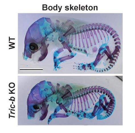 Genetic Mutation In Brittle Bone Disease Link EurekAlert