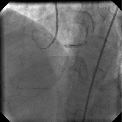 E Stent Being Deployed In Distal LMCA With Wires In Both LCA And RCA