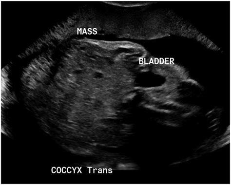 Teratoma Fetal Ultrasound