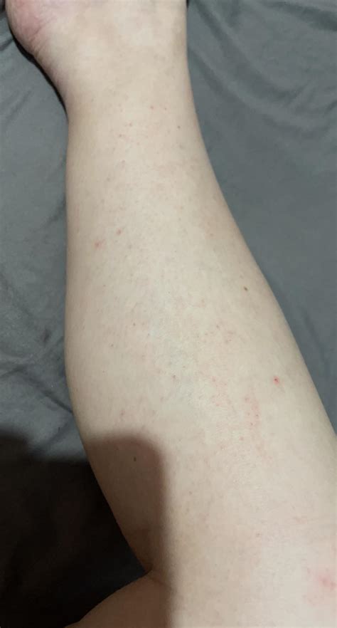 Post Scabies Or Active The Rash On My Arms Come And Go But On My Legs They Dont Seem To Go