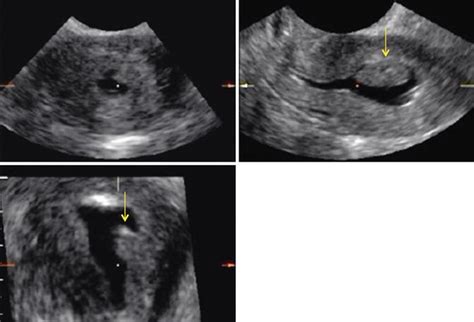 Endometrial Polyps Radiology Key