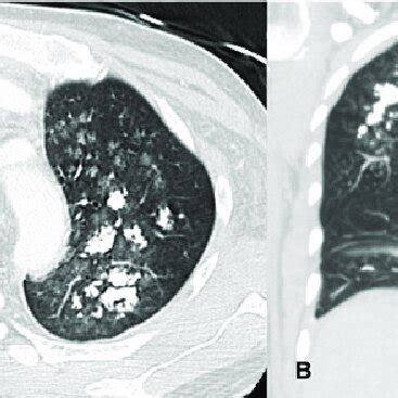 -(A) Axial and (B) Coronal chest CT scan showing multiple ground-glass ...