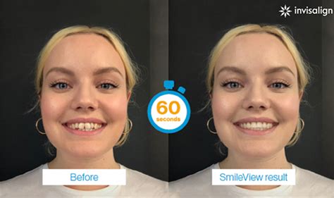 Invisalign Launches Smileview To Simulate Your New Smiledr Jacquie