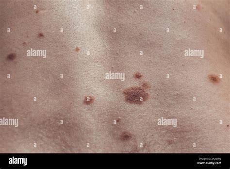 Melanocytic Nevus