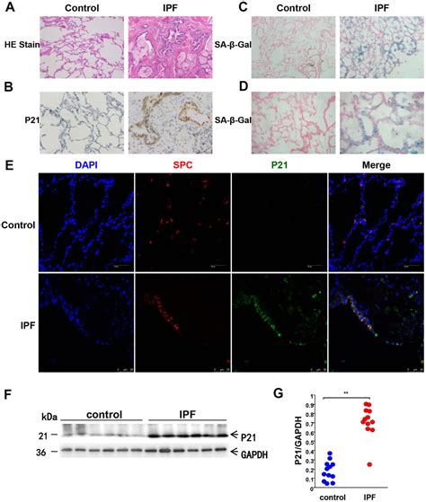 Pten Loss Regulates Alveolar Epithelial Cell Senescence In Pulmonary